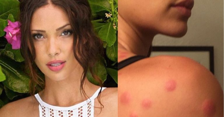 Model claims she was bitten by bed bugs at Palm Desert hotel, files lawsuit